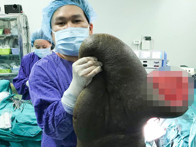 Tin tức trong ngày - Người đàn ông “cõng” chiếc "mai rùa" nặng 15kg suốt hơn 20 năm