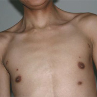 Phi thường - kỳ quặc - Chàng trai mọc tới 7 núm vú