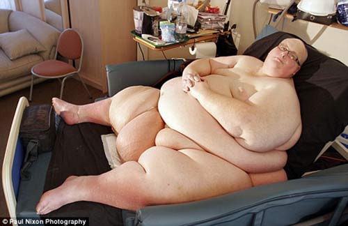 Giảm 290kg, người béo thừa 50 cân da - 1