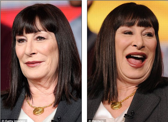 Nữ diễn viên Mỹ biến dạng sau thẩm mỹ - 2