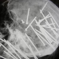 Sức khỏe đời sống - Rợn người những dị vật trong cơ thể người