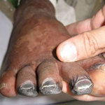 Cụt chân vĩnh viễn vì ăn lợn bệnh