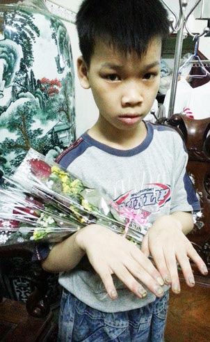 Chích thuốc lá đang cháy vào tay trẻ - 2