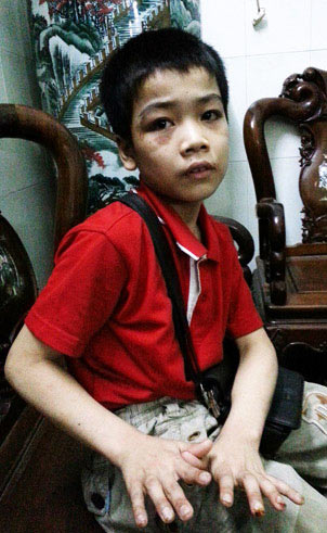 Chích thuốc lá đang cháy vào tay trẻ - 3