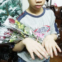 Tin tức trong ngày - Chích thuốc lá đang cháy vào tay trẻ