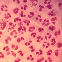 Sức khỏe đời sống - 12 căn bệnh luôn "rình rập" gái mại dâm