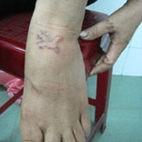 Sức khỏe đời sống - Cảnh giác với giun móc chó, mèo dưới da