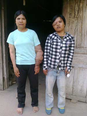 Nỗi đau chị em mang thân hình “quỷ ám” - 1