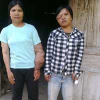 Tin tức trong ngày - Nỗi đau chị em mang thân hình “quỷ ám”