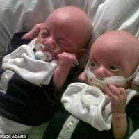 Tin tức trong ngày - Anh: Y tá dán băng dính vào miệng trẻ đẻ non