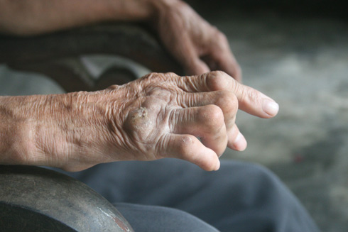 Kí ức kinh hoàng về "Đảo Hủi" - 1