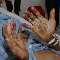 Sức khỏe đời sống - Thêm 16 người nhiễm liên cầu khuẩn lợn