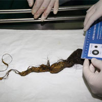 Phi thường - kỳ quặc - Búi tóc dài 23cm trong bụng bé gái