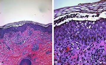 Trẻ bỏng da do tụ cầu - 1