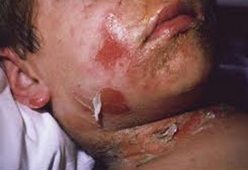 Trẻ bỏng da do tụ cầu - 2