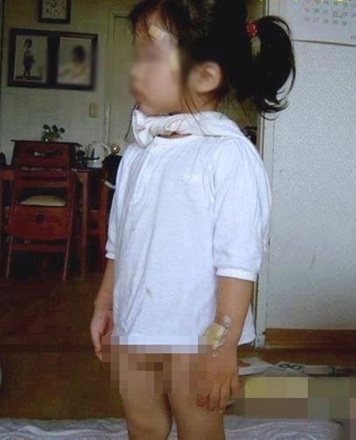 Bé gái 4 tuổi có 2 bộ phận sinh dục - 1