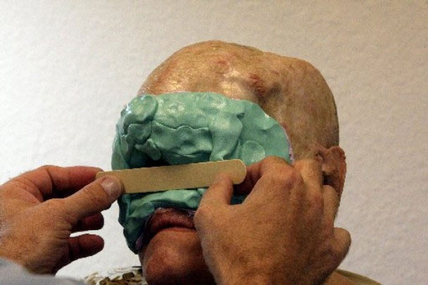 Cận cảnh tái tạo khuôn mặt biến dạng - 2