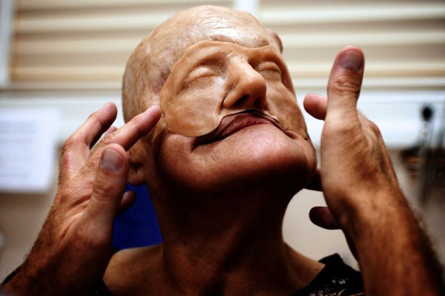 Cận cảnh tái tạo khuôn mặt biến dạng - 6