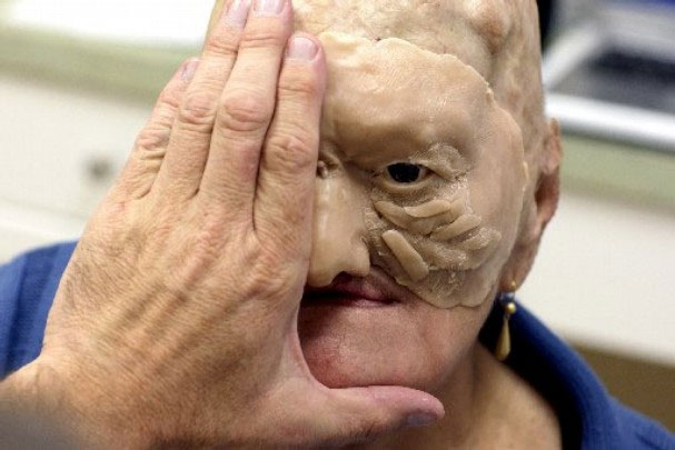 Cận cảnh tái tạo khuôn mặt biến dạng - 8