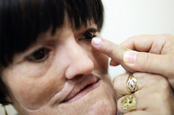 Cận cảnh tái tạo khuôn mặt biến dạng - 9