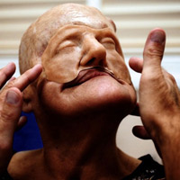 Sức khỏe đời sống - Cận cảnh tái tạo khuôn mặt biến dạng