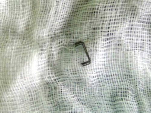 Lấy 3 ghim sắt gây mưng mủ trong phổi - 1