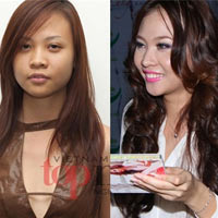 Thẩm mỹ viện - "Thần dược" nâng cao mũi không dao kéo