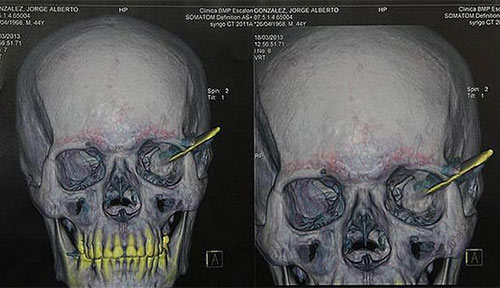 18 năm mới rút dao khỏi hộp sọ - 1