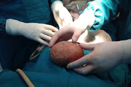 Hòn đá nặng gần 1 kg lấy từ bàng quang - 1