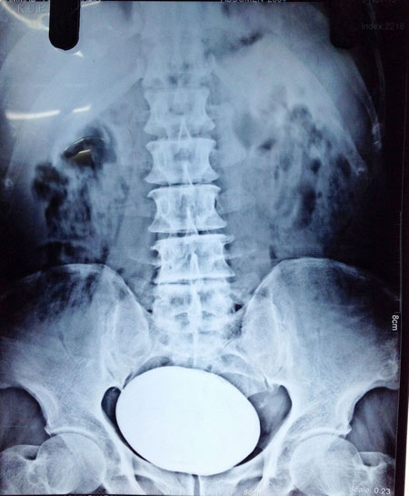 Hòn đá nặng gần 1 kg lấy từ bàng quang - 2