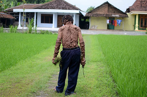 Người đàn ông mọc hàng ngàn khối u - 9