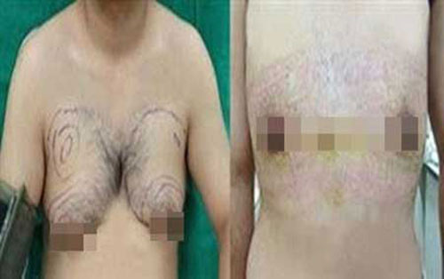 3 chàng trai ngực "to hơn phụ nữ" - 2