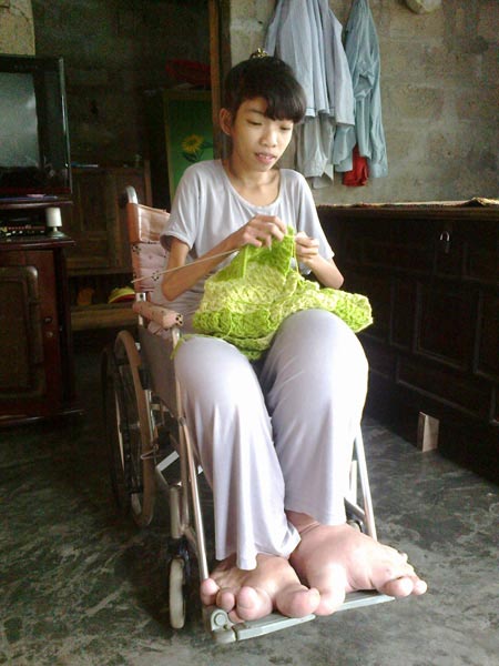 Cô bé chân voi vượt lên nghịch cảnh - 2