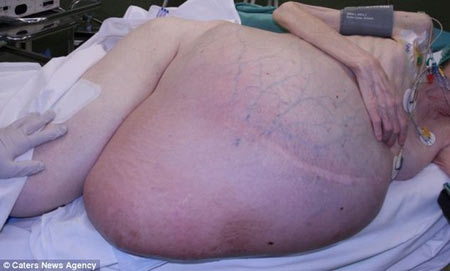 Phẫu thuật lấy khối u hơn 38 kg - 1