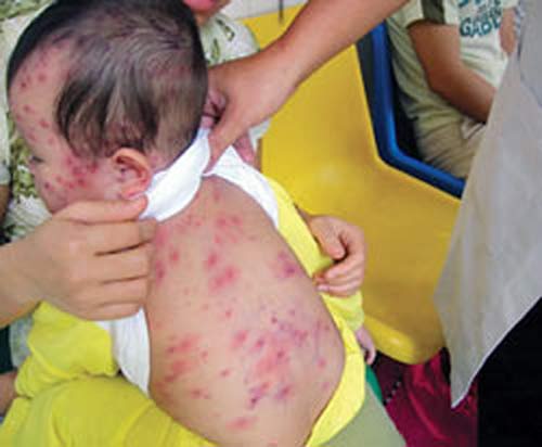 Dịch sởi bùng phát do trẻ chưa tiêm vắc xin - 1