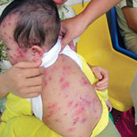 Dịch sởi bùng phát do trẻ chưa tiêm vắc xin