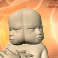 Sức khỏe đời sống - Dính liền hiếm gặp: Bào thai có hai mặt đối xứng nhau