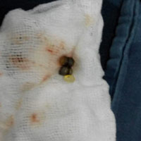 Sức khỏe đời sống - Bé 14 tháng tuổi suýt mất mạng do nuốt dị vật