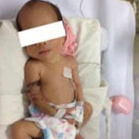 Sức khỏe đời sống - Cứu cánh tay bị hoại tử nặng cho bé sinh non