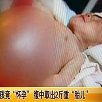 Sức khỏe đời sống - Bé trai 2 tuổi "mang thai" người anh em sinh đôi