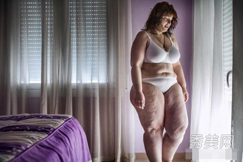 Cô gái 31 tuổi cắt dạ dày để giảm béo - 1