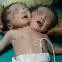 Phi thường - kỳ quặc - Nhói lòng cặp sinh đôi chung một cơ thể