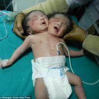 Sức khỏe đời sống - Thêm một bé gái hai đầu chào đời tại Ấn Độ