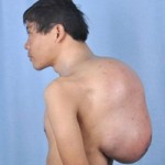 Phi thường - kỳ quặc - Cảm thương “chàng gù” mang khối u 13kg trên lưng