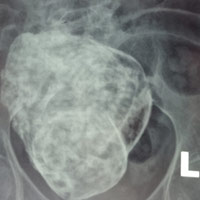 Sức khỏe đời sống - Phát hiện "thai đá" trong bụng bà cụ 76 tuổi