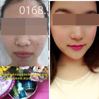 Bí quyết làm đẹp - Sợ hãi cách trị mụn bằng nước rửa phụ khoa