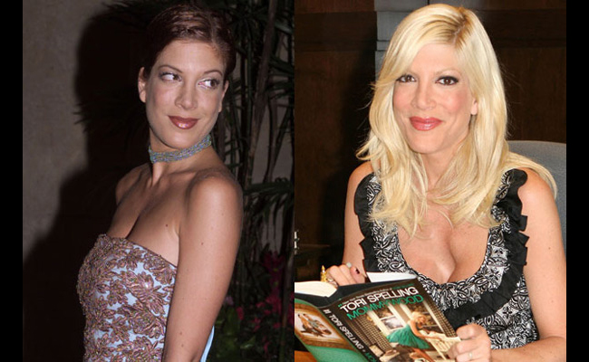 Nữ diễn viên Tori Spelling phải chịu một vết lõm kỳ cục ở vòng 1. Nguyên nhân sự biến dáng này bắt nguồn &nbsp;từ việc sửa sang ngực của cô
