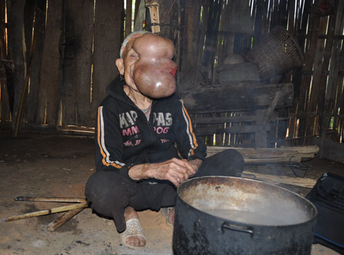 Xót xa người đàn bà “không mũi” - 2