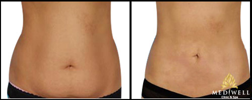 Giảm béo miễn phí, duyên dáng đón hè - 3