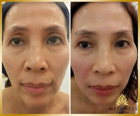 Cực hot: Miễn phí trẻ hóa da 10 tuổi với công nghệ nâng cơ HIFU - 2